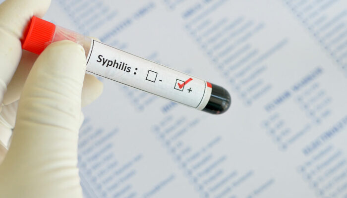 Syphilis – Early Signs and Diagnosis