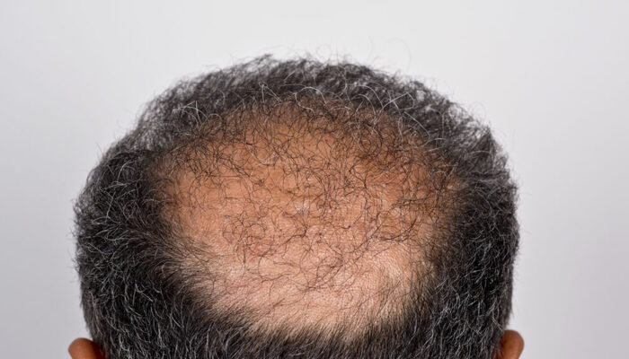 Hair Transplant – Types, Procedure, and Cost