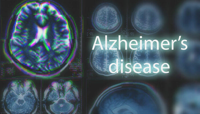 10 Early Signs of Alzheimer’s Disease