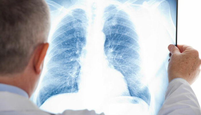 A few things you should know about mesothelioma cancer