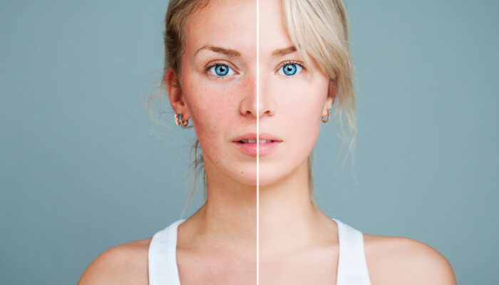 All You Need to Know About Rosacea