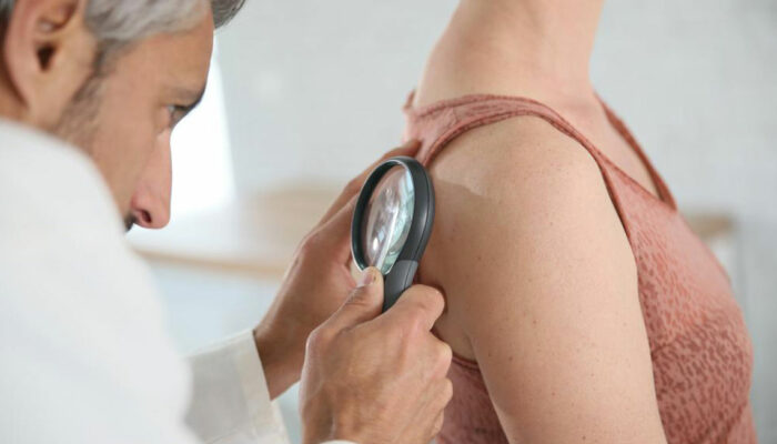 Get rid of shingles by knowing the best treatment options