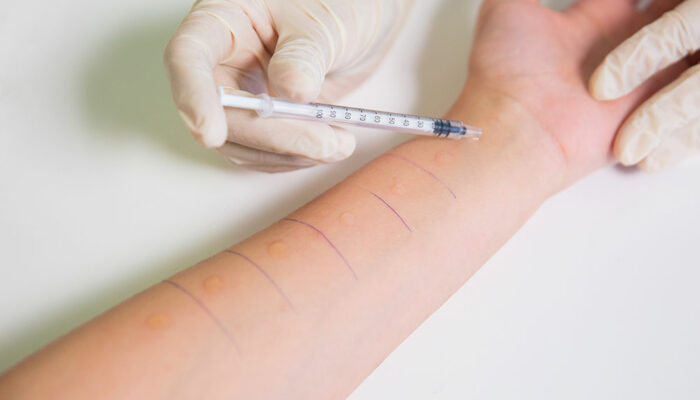 Here’s how you can get your allergies detected