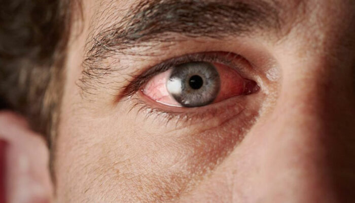 Sjogren’s Syndrome- Causes and Symptoms