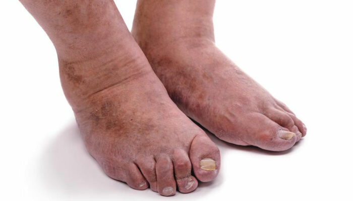 4 important things you need to know about rheumatoid arthritis