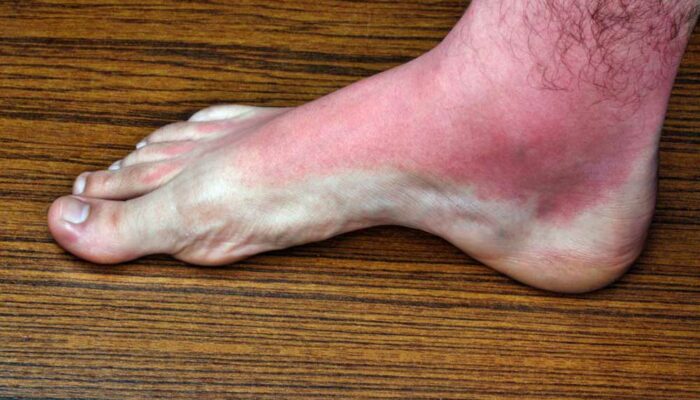 7 Common Causes of Itchy Rashes on Legs