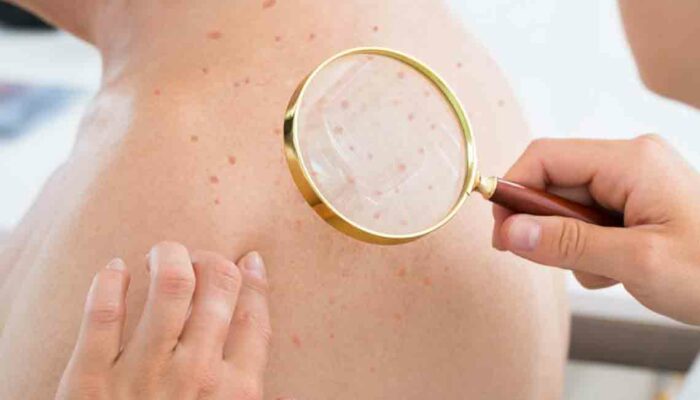 Atopic Dermatitis Eczema – Causes, Symptoms, and Treatments