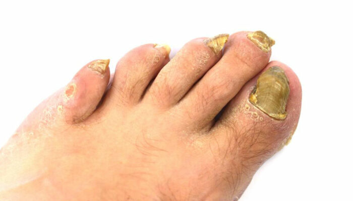 An Effective Way to Treat Toenail Fungus – Hydrogen Peroxide