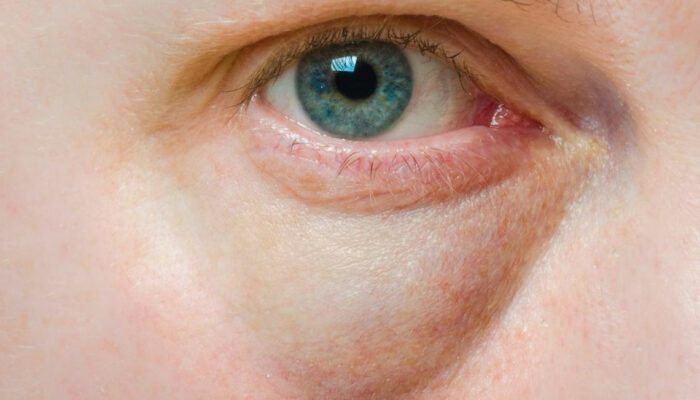 Bags Under the Eyes – Symptoms, Causes, and Treatment