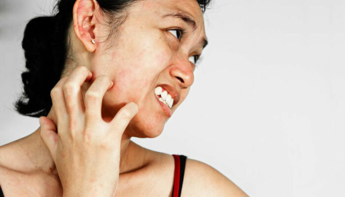 Everything You Need to Know about the Treatment for Rosocea