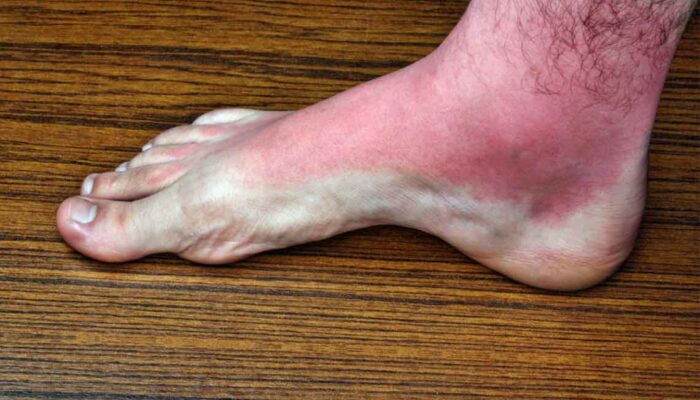 Heat rash: Causes, symptoms, and treatment