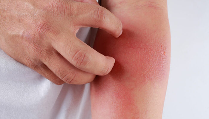Here’s How to Identify a Skin Rash