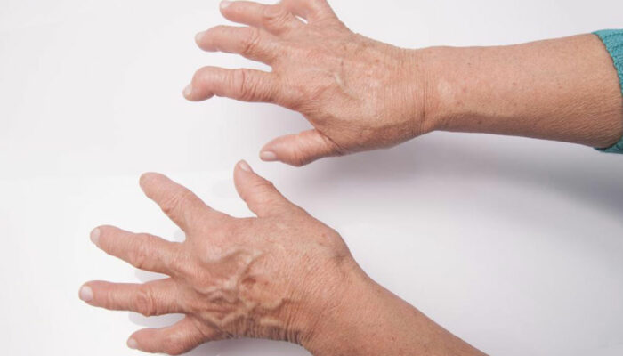 Here’s What You Need to Know About Rheumatoid Arthritis Symptoms