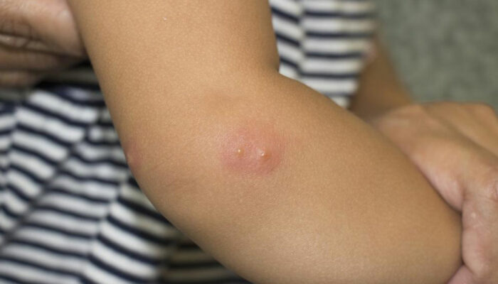 Here’s What You Need to Know about Shingles and Its Symptoms