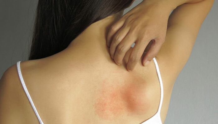 Here’s what you should know about allergies and how to treat them