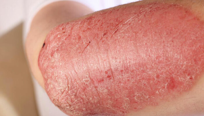 Immune system disorder – Symptoms, causes, and risks