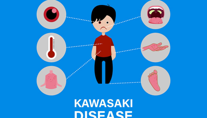 Kawasaki disease – causes and symptoms