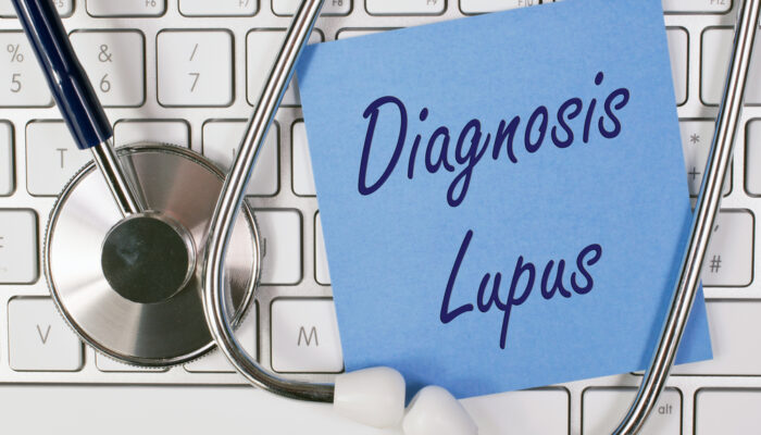 Know about the different ways to diagnose lupus