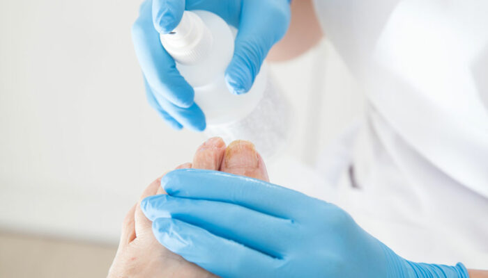 Toenail Fungus – Symptoms and Treatment Methods