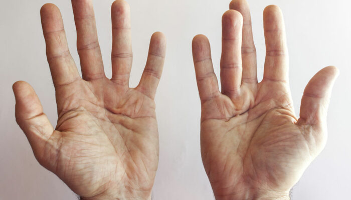 4 hand exercises for Dupuytren’s contracture patients