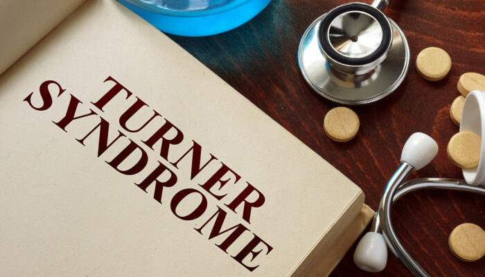 Turner Syndrome – Causes, Symptoms, and Management