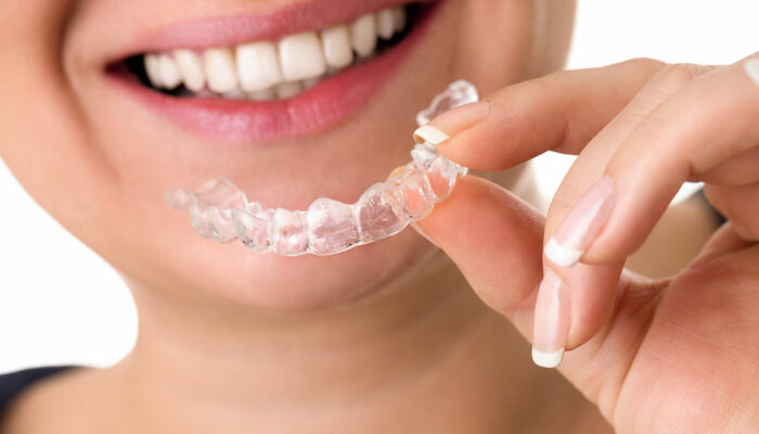 An overview of invisible teeth aligners braces