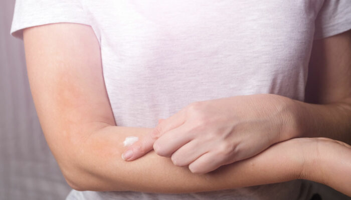 Itchy Skin – Best Anti-Itch Creams and Home Remedies